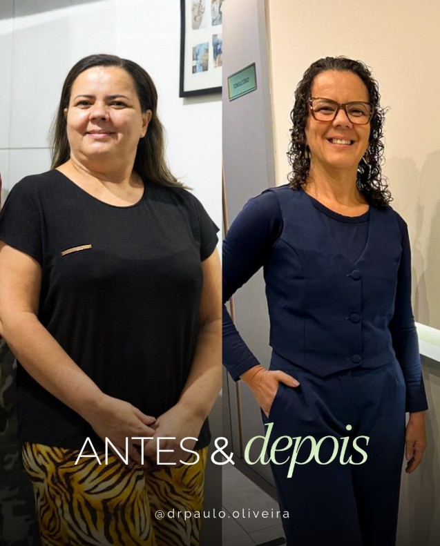 Paciente antes e depois do acompanhamento com Dr. Paulo Oliveira